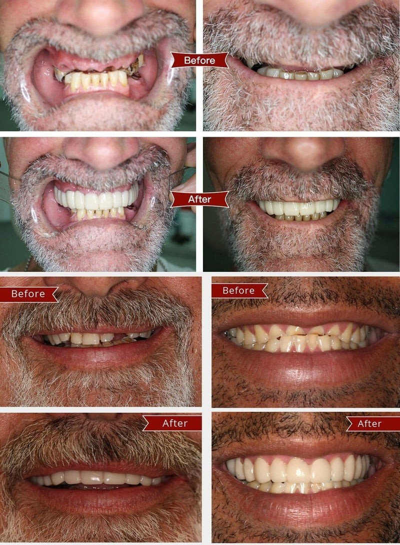 Snap-On Smile Veneers™ - Τελειοποιήστε αμέσως το χαμόγελό σας! - Αγοράστε 1 και πάρτε 1 δωρεάν